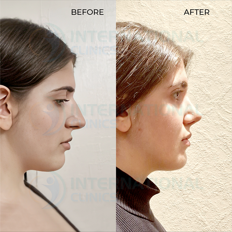 Rhinoplastie avant et après 4